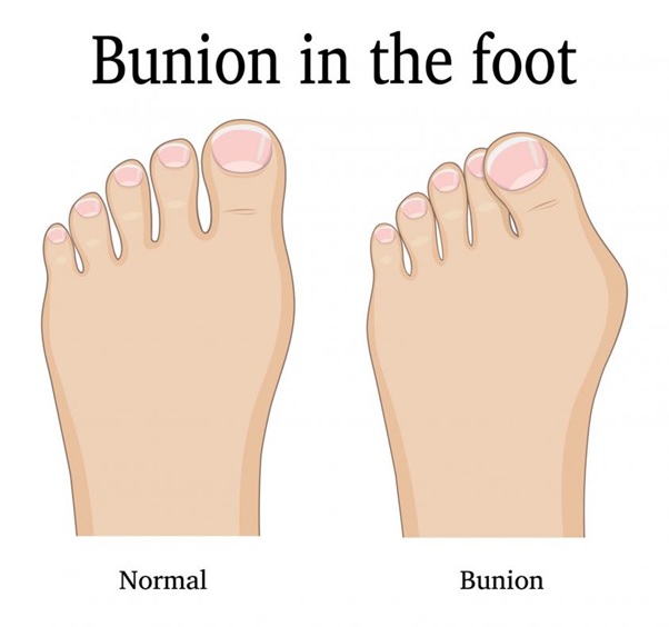 bunion